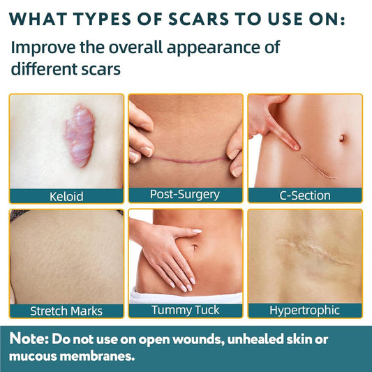 Medical Grade Silicone Scar Treatment Sheets